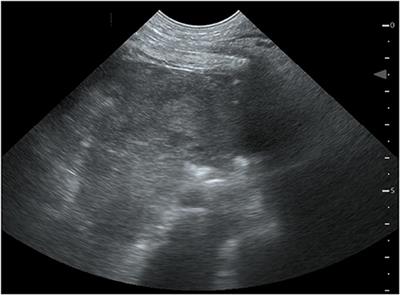 Life-Threatening Mediastinal Hematoma Formation After Removal of the Hemodialysis Catheter in a Boxer: A Case Report